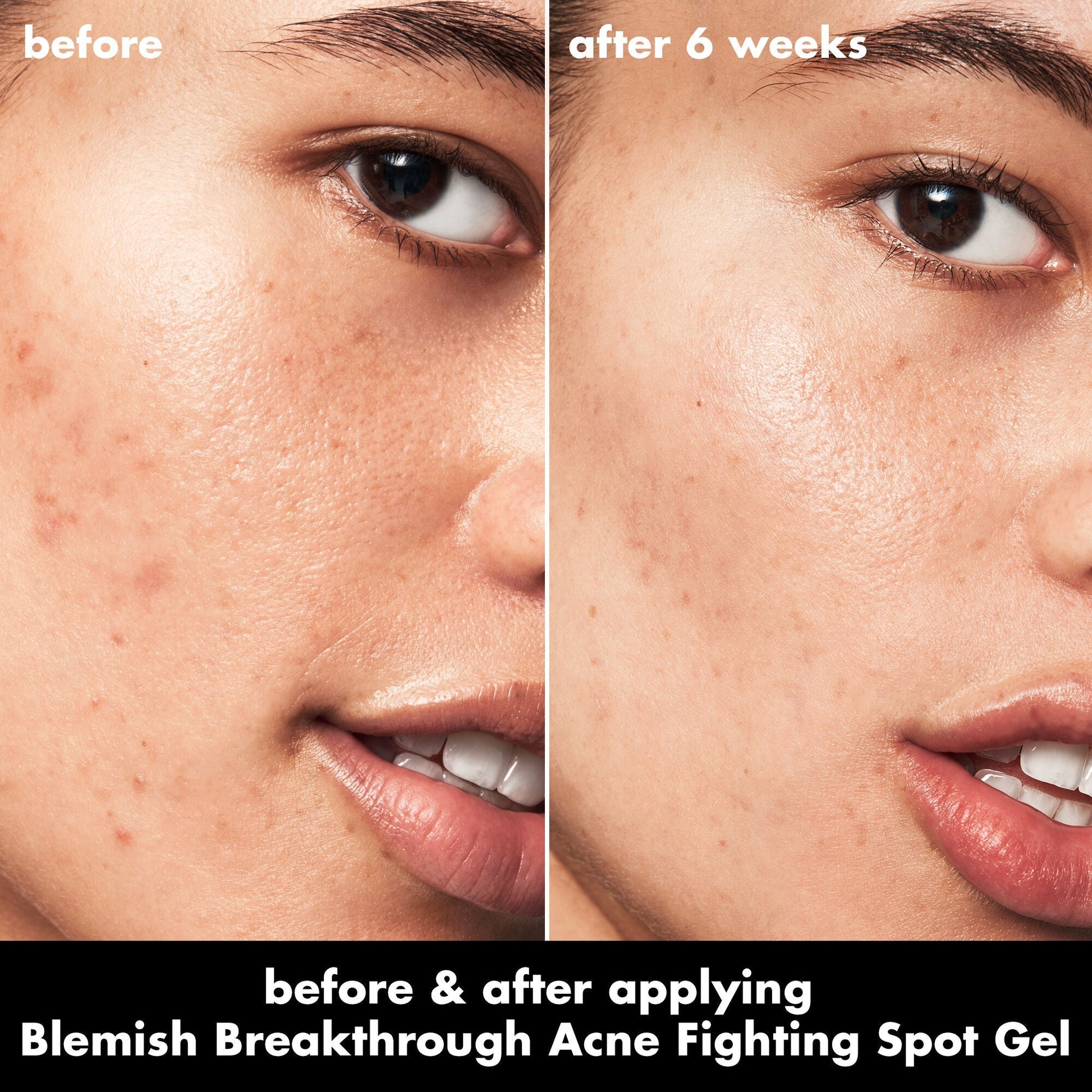 blemish-breakthrough-acne-fighting-spot-gel-t9 0326_EDU_BB_SpotGel_BA_ISABELLA.jpg
