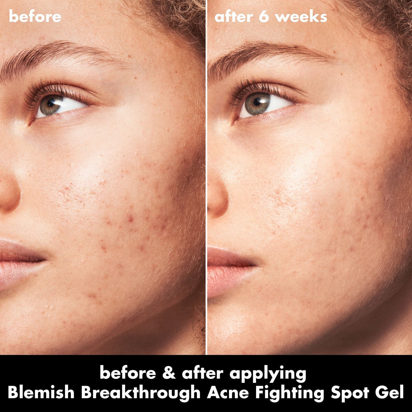 blemish-breakthrough-acne-fighting-spot-gel-t9 0326_EDU_BB_SpotGel_BA_MARLEY.jpg
