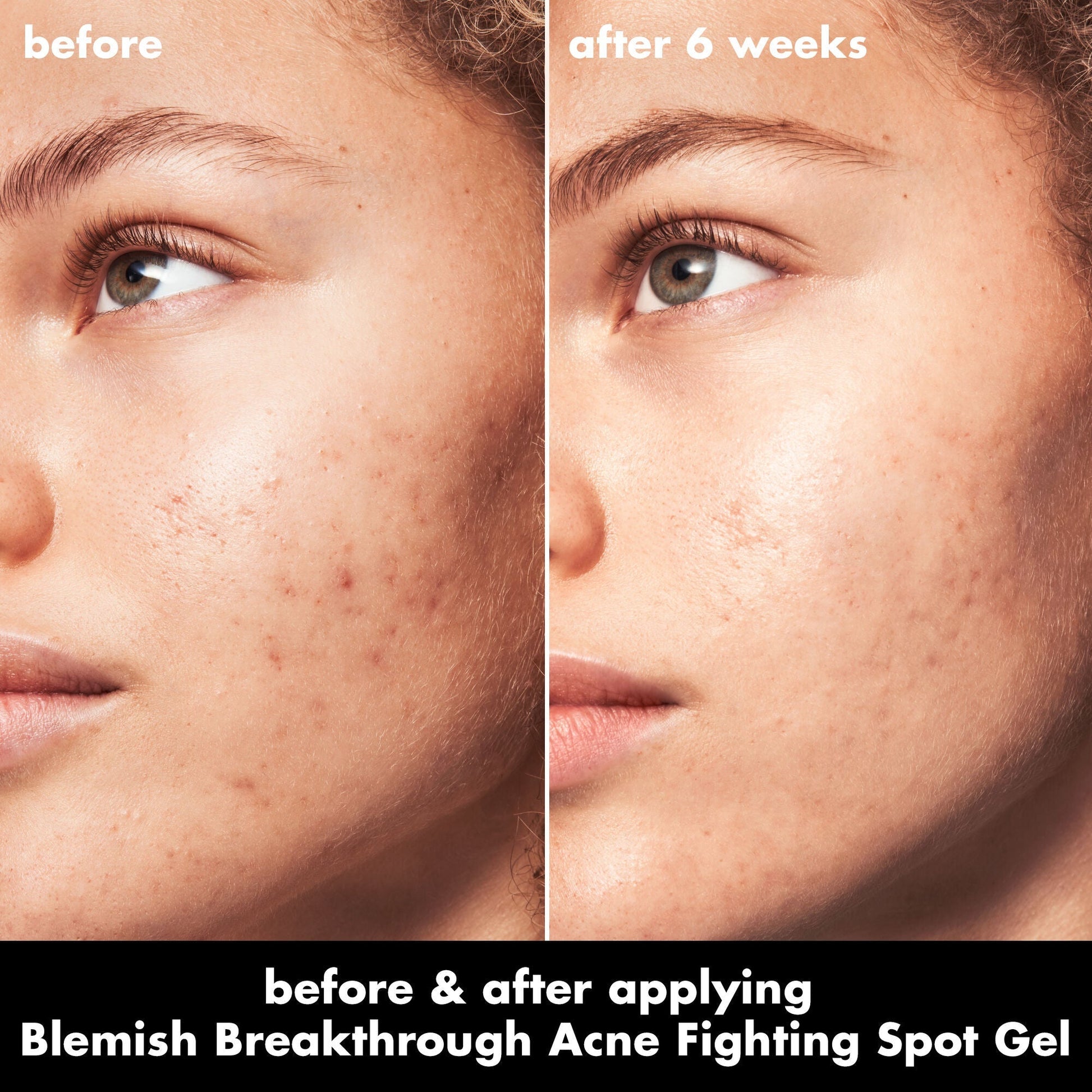 blemish-breakthrough-acne-fighting-spot-gel-t9 0326_EDU_BB_SpotGel_BA_MARLEY.jpg