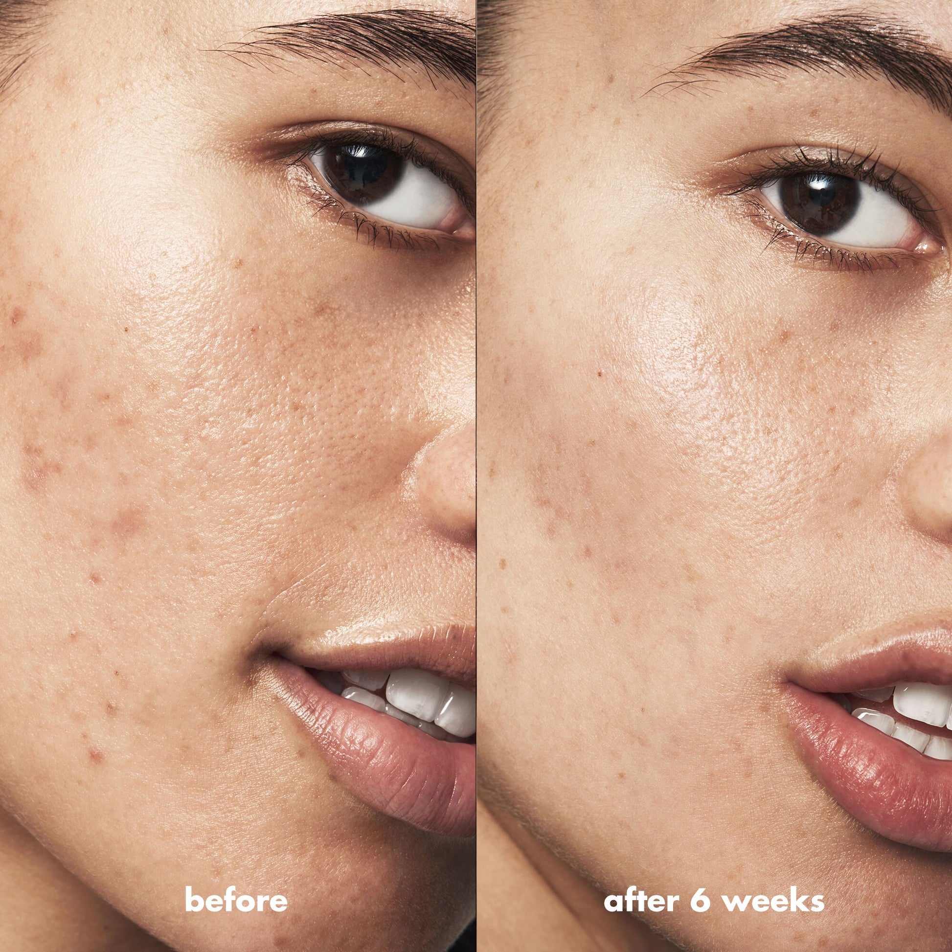 blemish-breakthrough-triple-acid-resurfacing-serum-m3 Acne_PDP_Isabella_Before_After_b8fe0505-ae5c-4baa-9a8e-fd889e4c3414.jpg