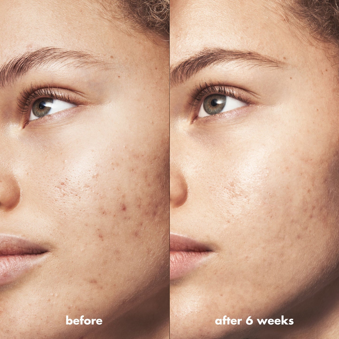 blemish-breakthrough-blemish-control-basics-kit-d3 Acne_PDP_Marley_Before_After_295728d2-6728-4f48-b8ef-c82bbca5b591.jpg